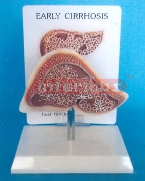 DESK TYPE EARLY CIRRHOSIS MODEL WITH DESCRIPTION PLATE